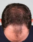 Before Hair Transplant&nbsp;Front